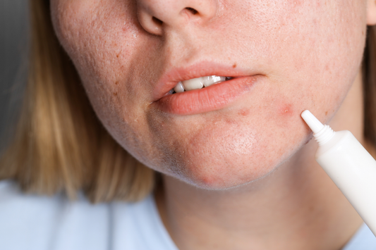 Simple skincare for adults with hormonal acne